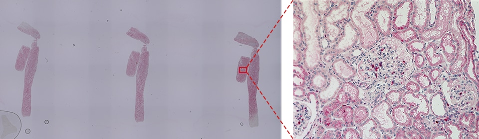 CD68（巨噬细胞）的肾小球占比分析事例